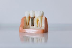 Single Dental Tooth Implant