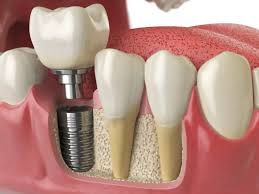 Side effects of dental implants