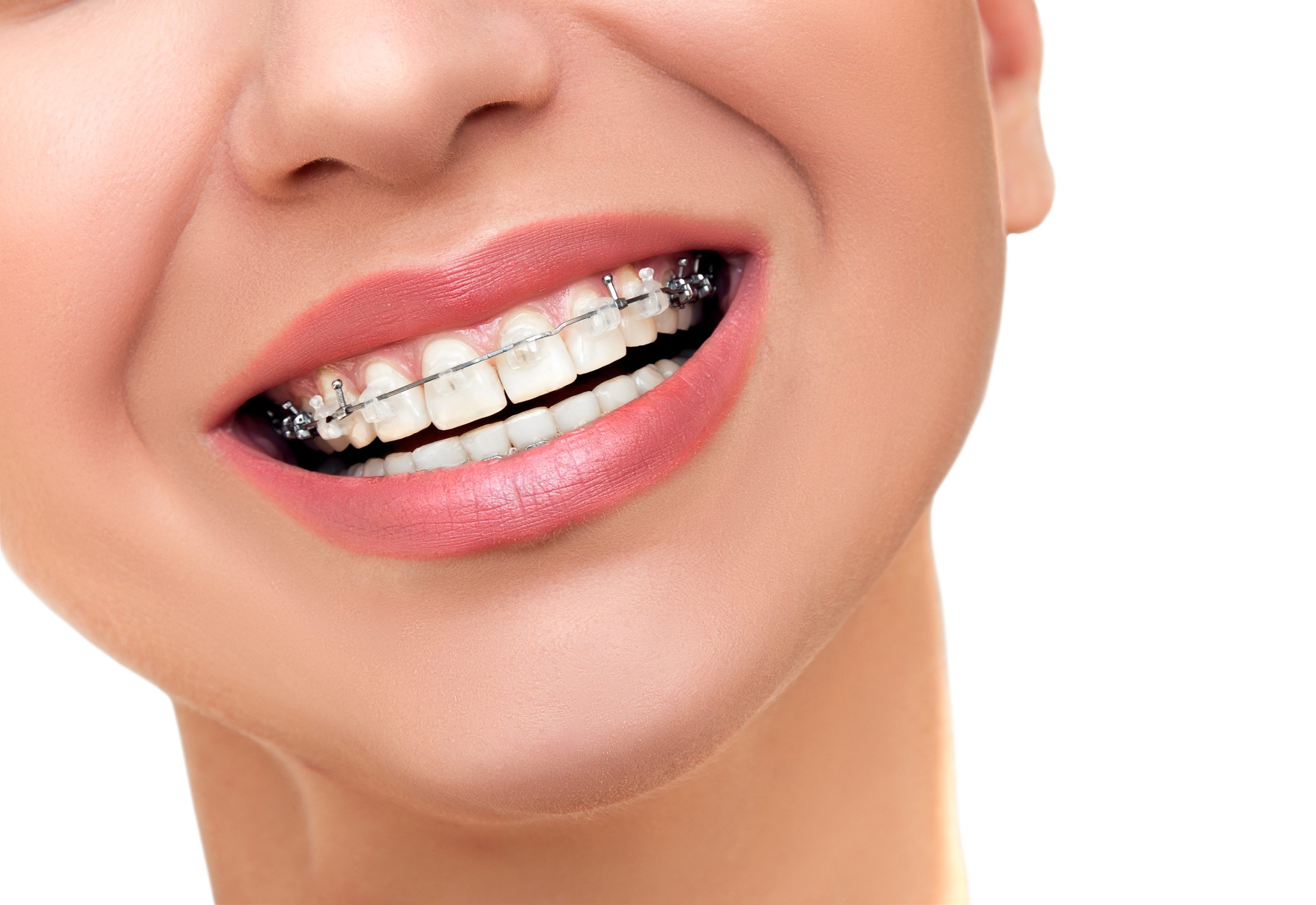 Affordable Mukwonago Braces: Cost-Effective Solutions