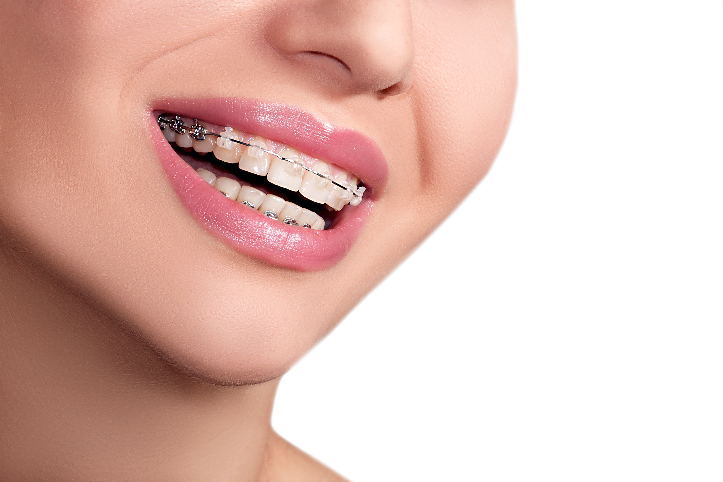 Mukwonago Braces Options: Finding The Best Fit For You